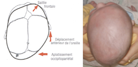 Soigner et prévenir la plagiocéphalie